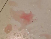 小便带血是什么原因,揭秘常见原因与应对策略